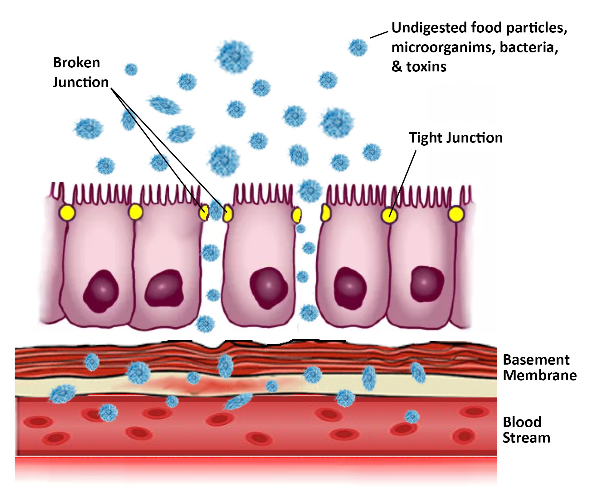 IgG Antibodies to foods may be suggestive of Leaky Gut syndrome